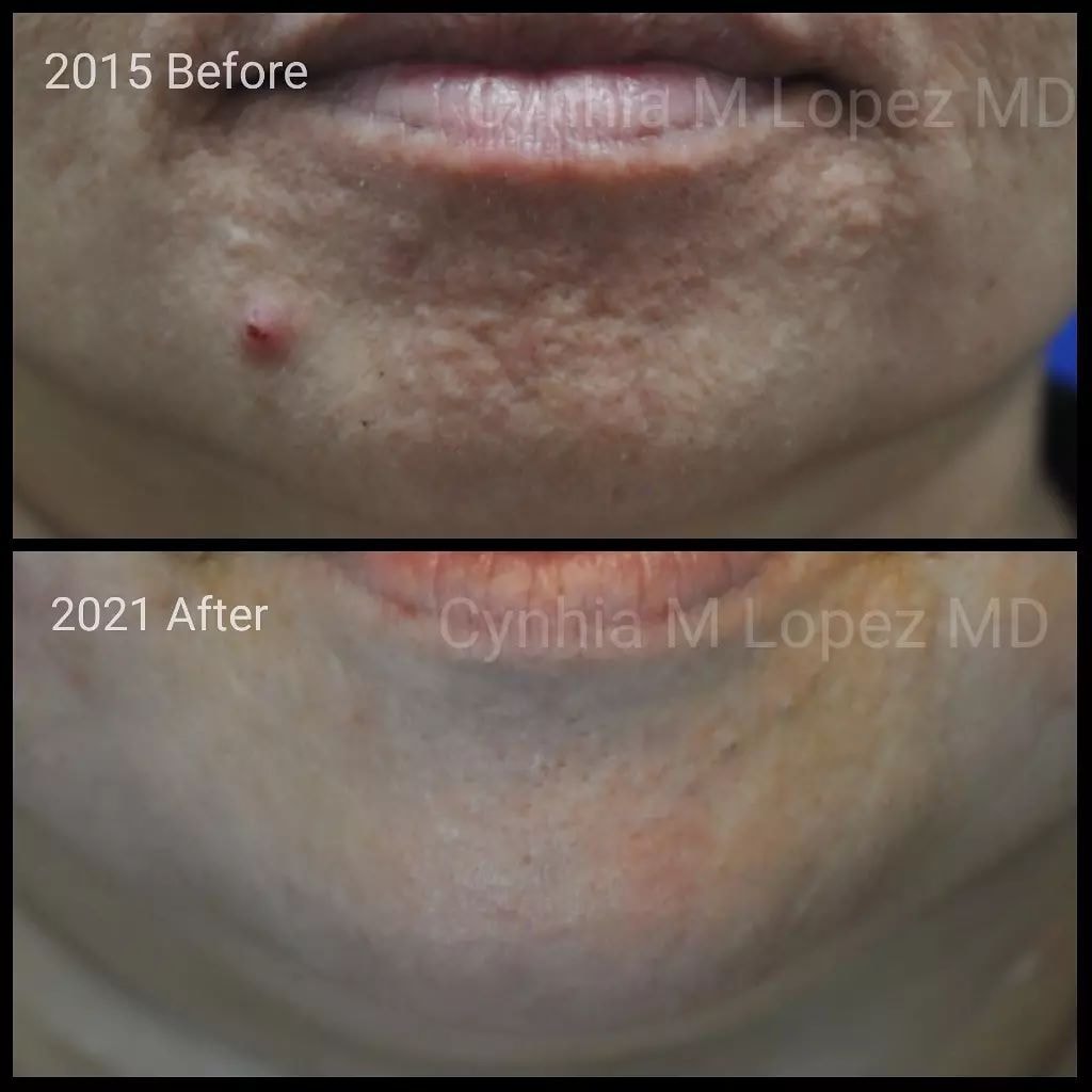 Acne scar before 2015 and after 2021 — upper lip area