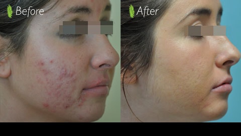 Acne scar treatment before and after — side profile