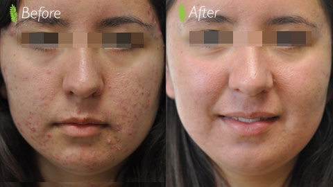 Acne scar treatment before and after — front view