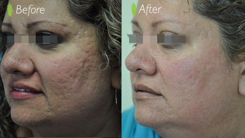 Acne scar treatment before and after — cheek side profile