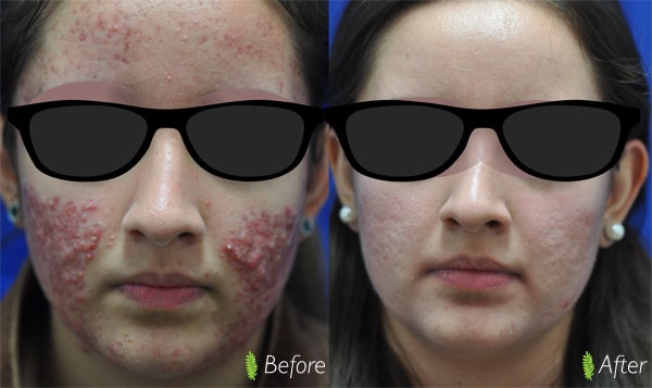 Acne and acne scar treatment before and after