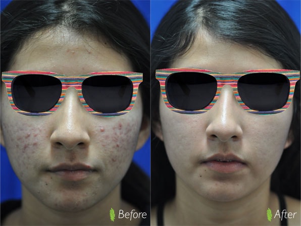 Acne scar treatment before and after — front view with sunglasses