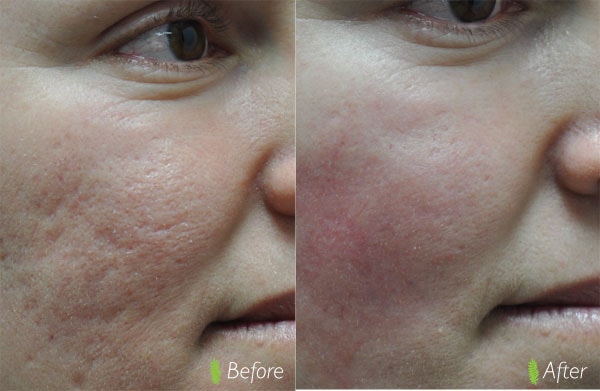 Acne scar close-up before and after treatment