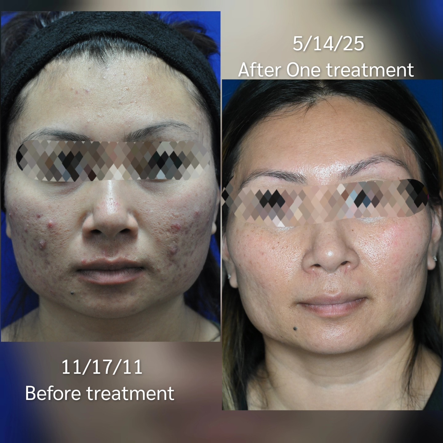 Acne treatment before and after one treatment