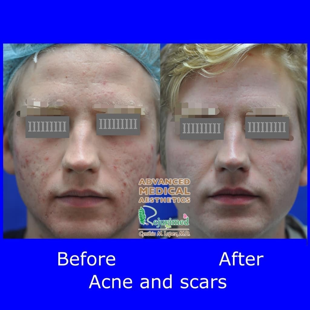 Acne and scars before and after treatment — front view
