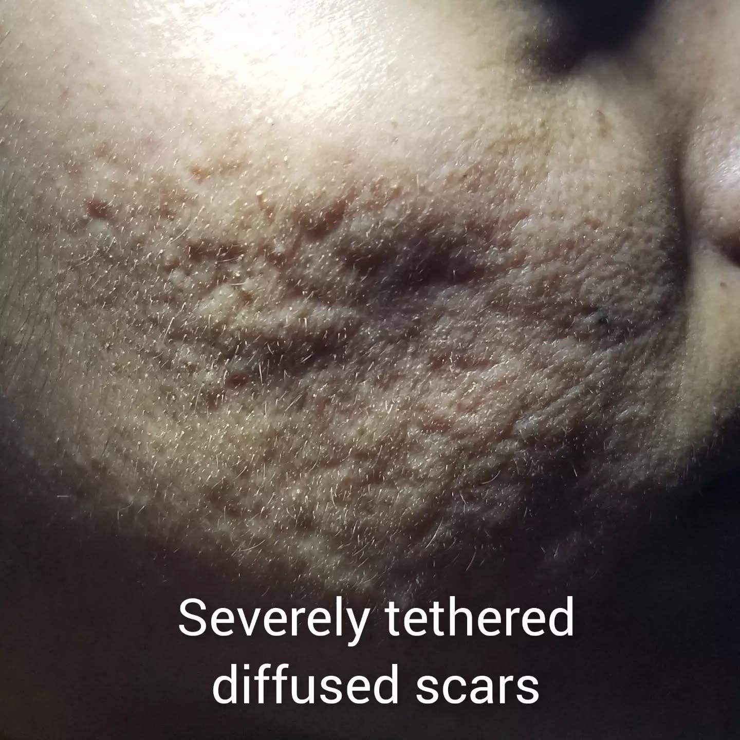 Severely tethered diffused acne scars — close-up