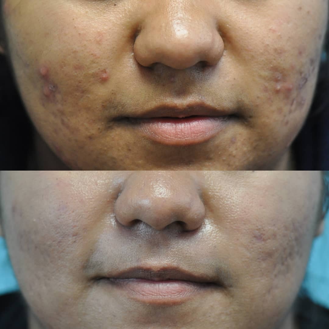Acne and acne scars before and after — lower face close-up