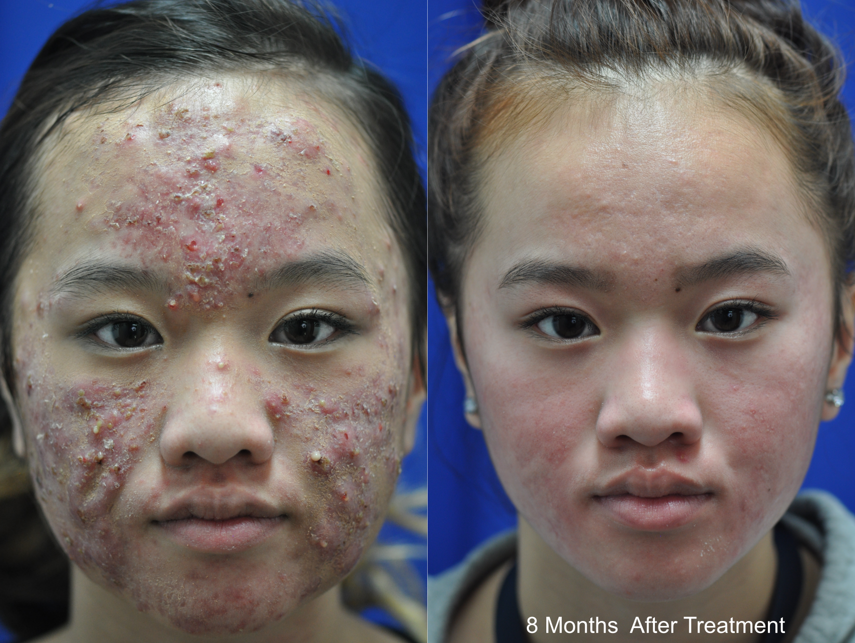 Acne scar treatment results — animated before and after