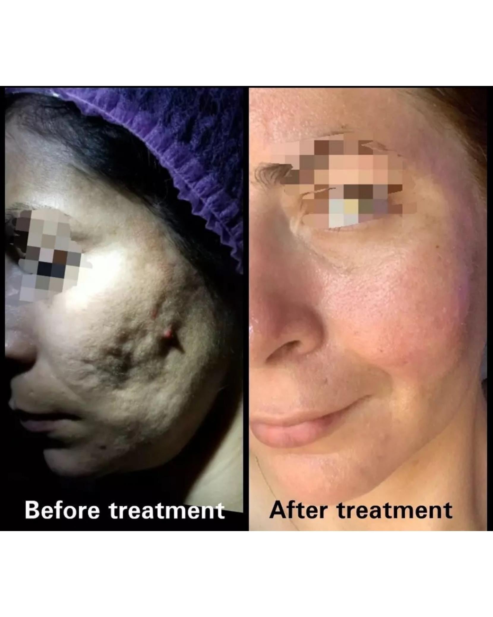 Acne scar before and after treatment — cheek close-up