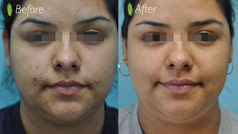 Acne scar treatment before and after — female patient, full face front view