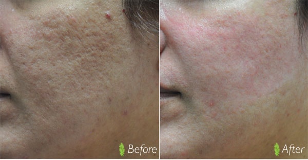 Acne scar treatment before and after — close-up cheek, rolling scars improved