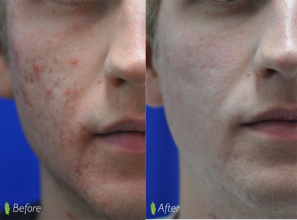 Acne scar treatment before and after — male patient, cheek close-up, significant improvement