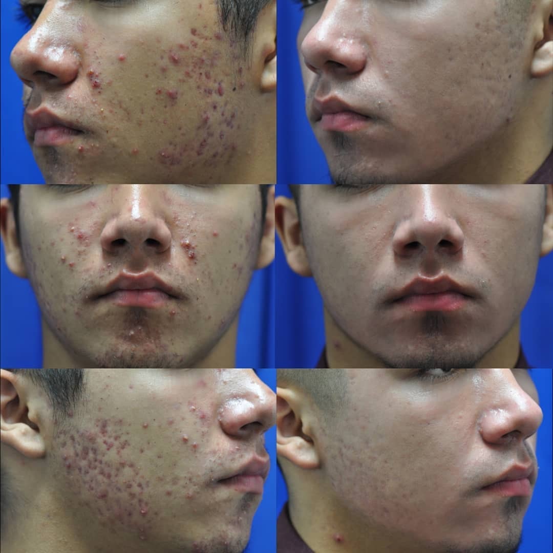 Acne scar before and after — male patient, cheek and side profile