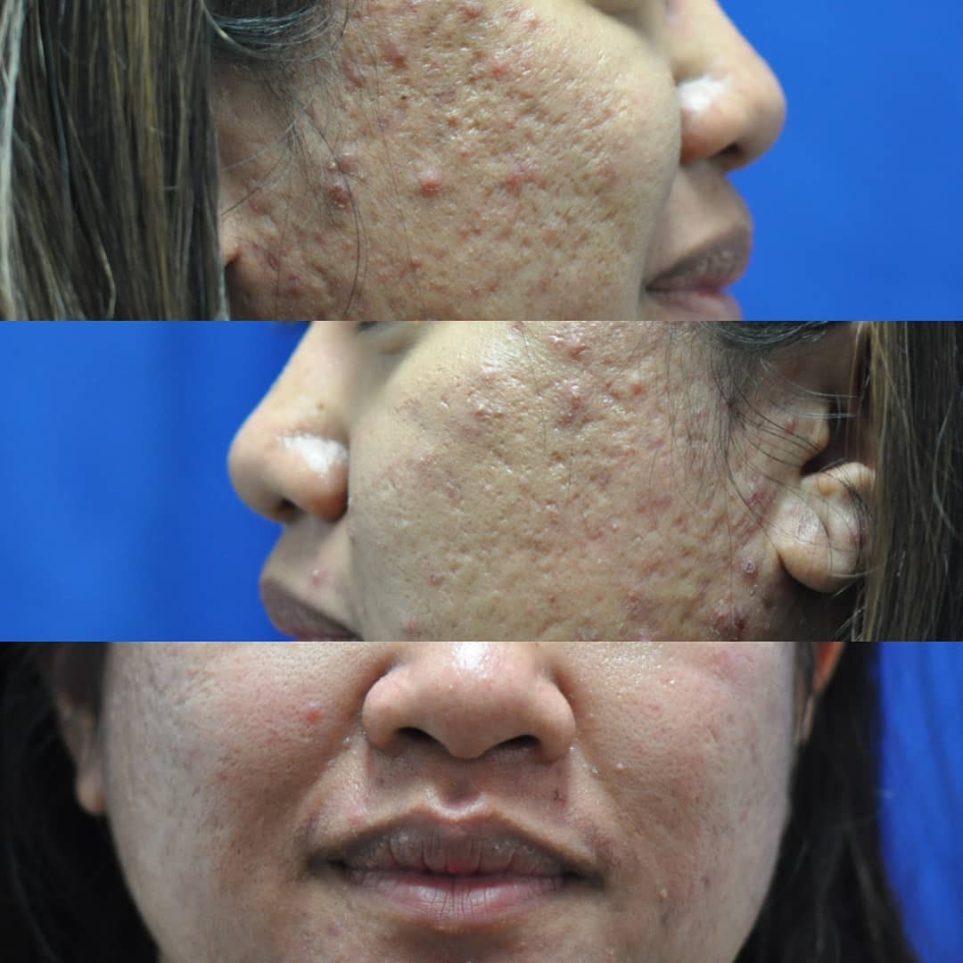 Acne scar before and after — female patient, side profile