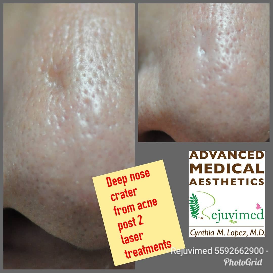 Deep nose crater from acne post 2 laser treatments — before and after