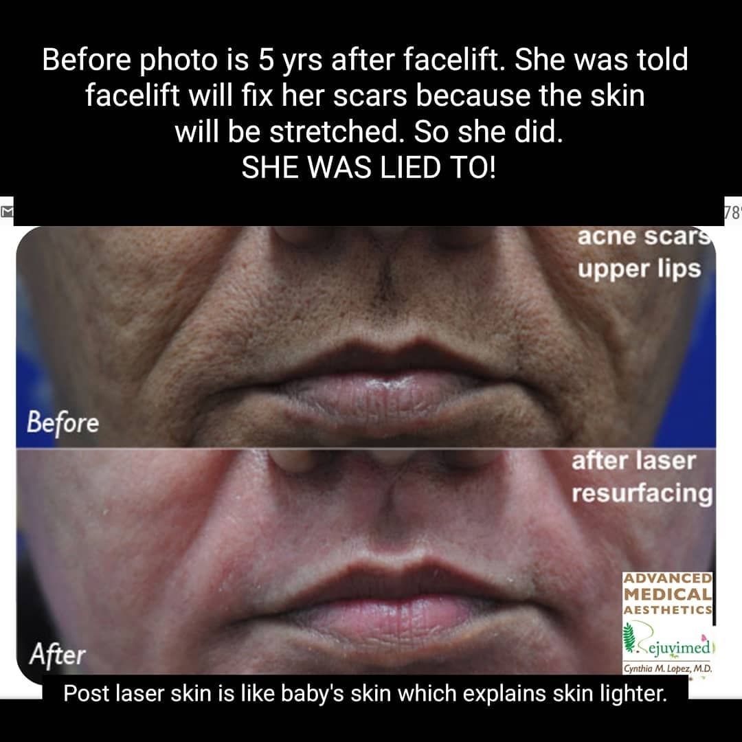 Acne scars upper lips before and after laser resurfacing
