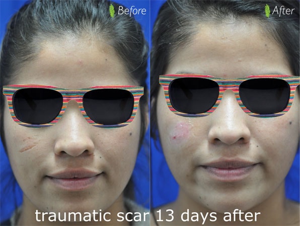 Traumatic scar 13 days after treatment — before and after