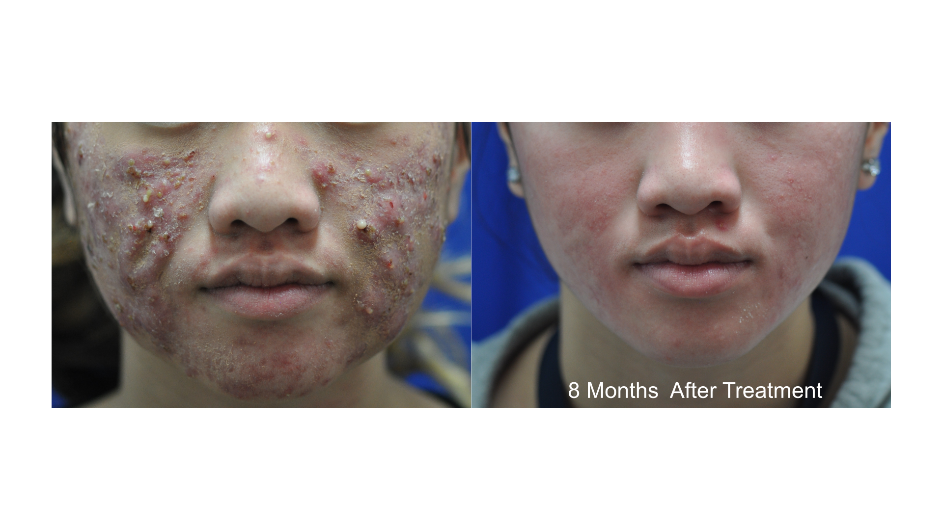Patient before and after acne treatment — 8 months after treatment at Rejuvimed