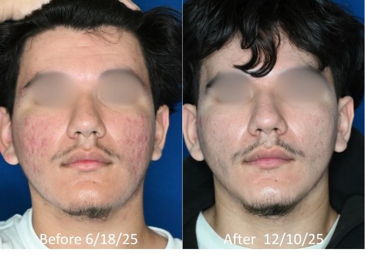 Zavala — acne scar treatment before and after, front and side profiles