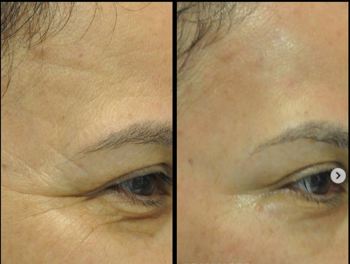 Before and after — crow's feet wrinkle reduction 10 days after Botox
