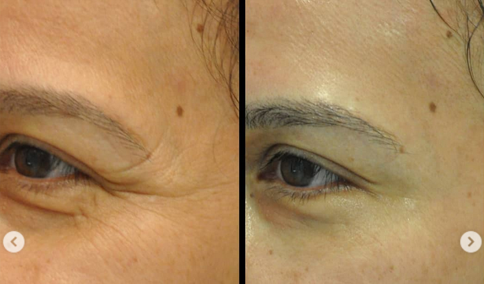 Close-up before and after — crow's feet wrinkle reduction after Botox