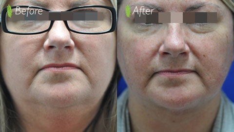 Double chin before and after — front view