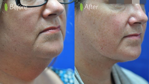 Double chin before and after — three-quarter view