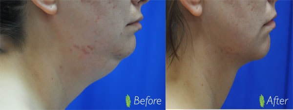 Double chin before and after — neck liposuction result