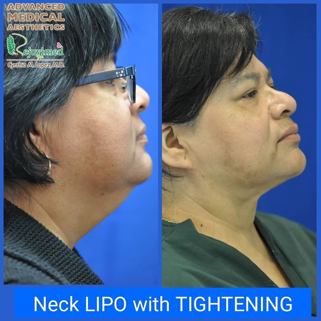 Neck lipo with tightening — side profile before and after