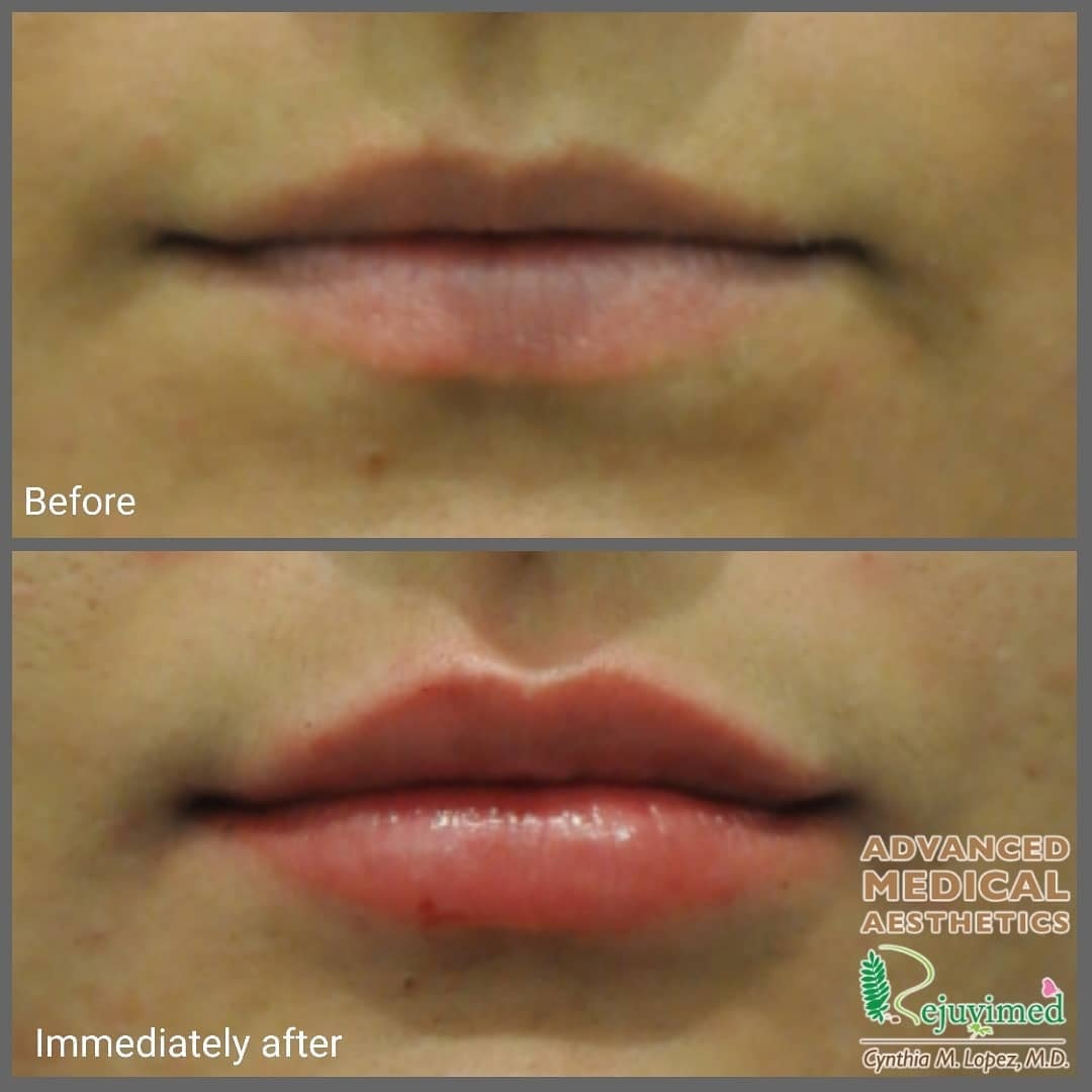 Lip filler before and after – immediately after treatment, patient 1