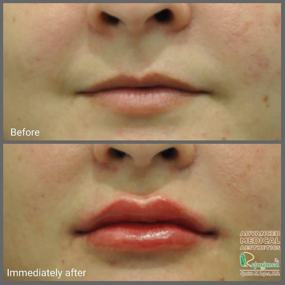 Lip filler before and after – immediately after treatment, patient 2