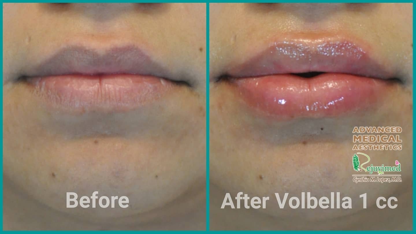 Lip filler before and after – after Volbella 1cc