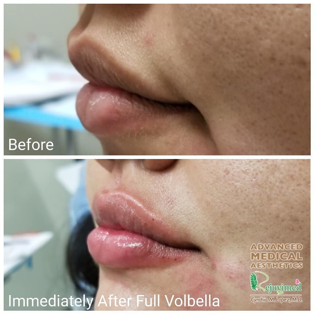 Lip filler before and after – immediately after full Volbella, lateral view