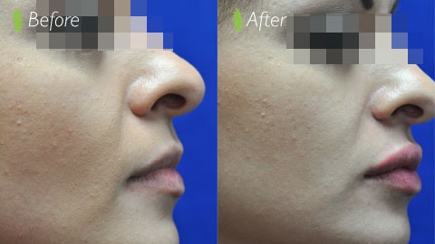 Lip filler before and after – side profile showing natural lip enhancement