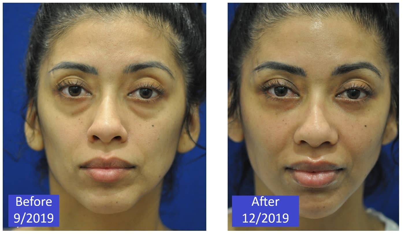 Female patient before and after dermal fillers — cheek and undereye fullness restored