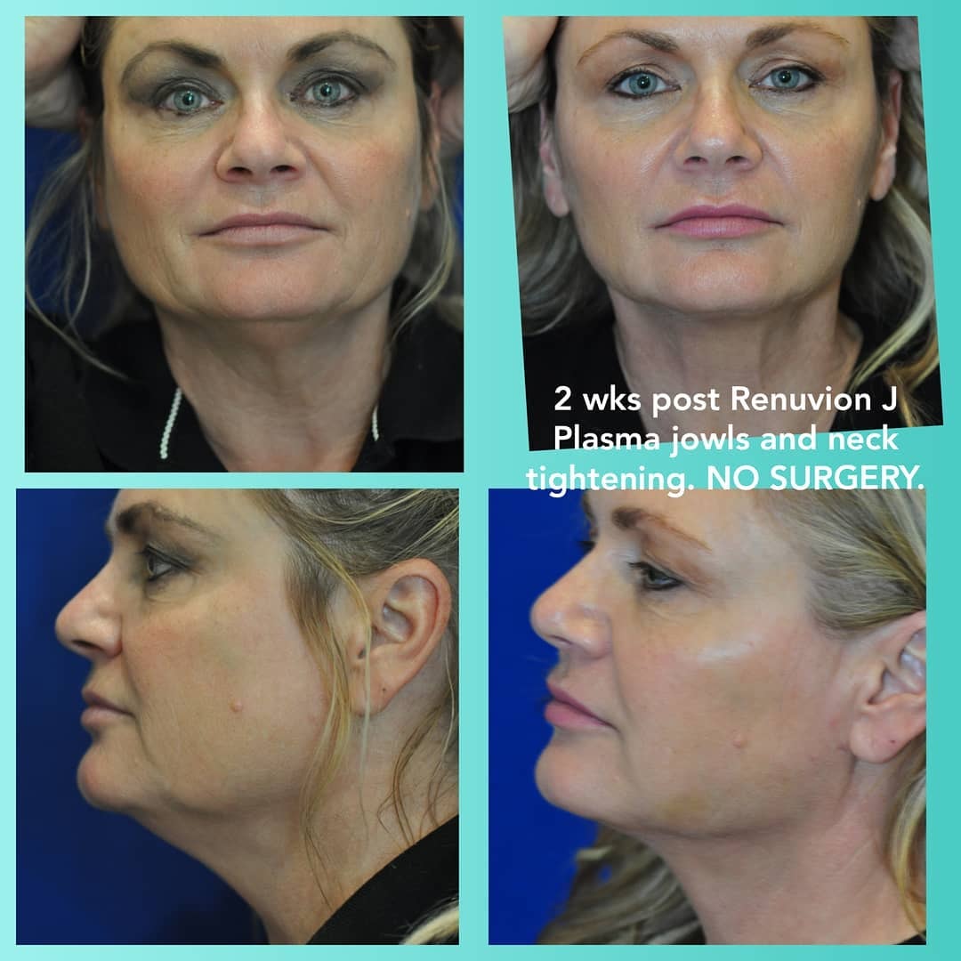 Female patient before and after — dermal fillers for cheeks and Renuvion J Plasma for jawline and neck tightening