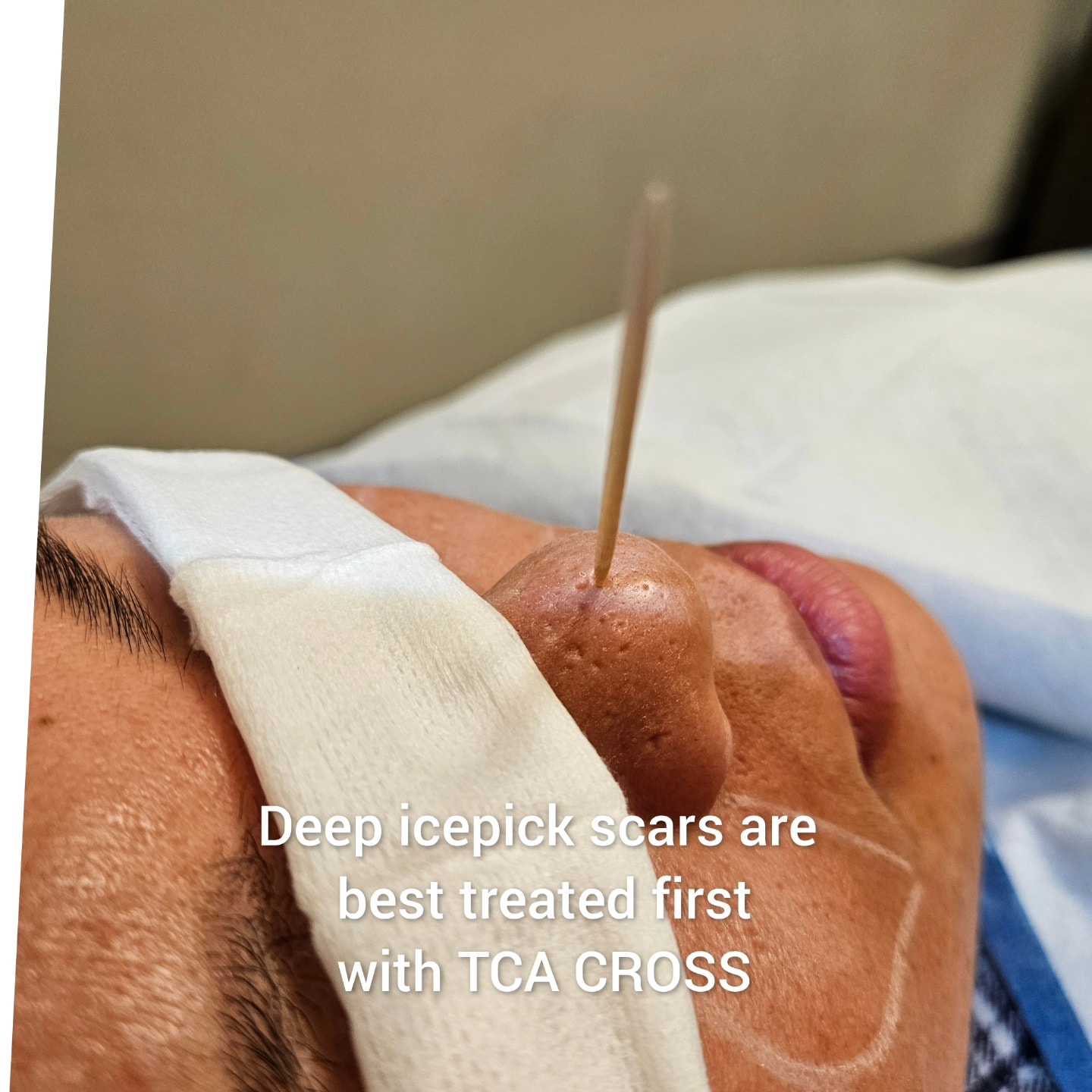 Toothpick standing upright in an ice pick acne scar on the nose, demonstrating the scar's remarkable depth