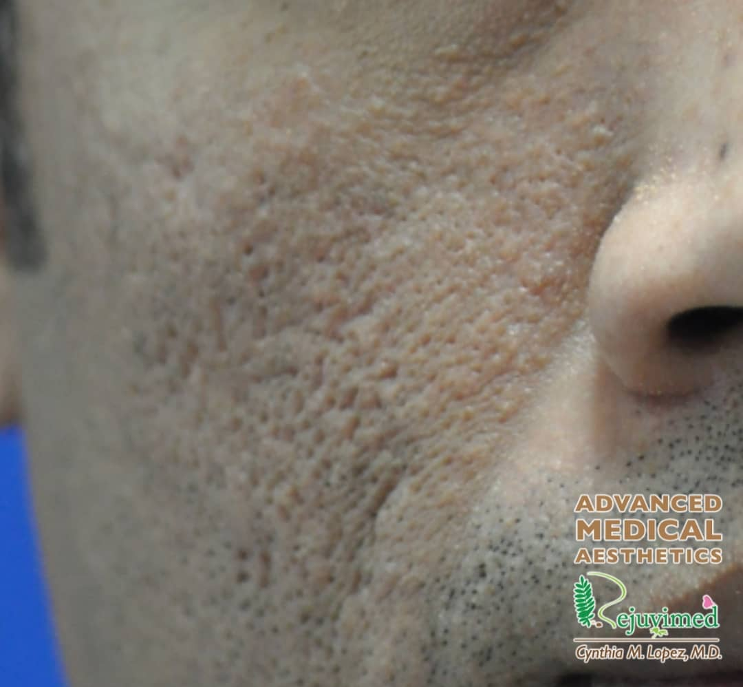 Close-up of deep ice pick acne scars on skin