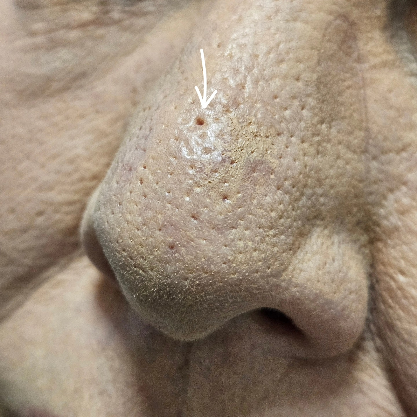 Skin with ice pick acne scars that appear more textured under makeup