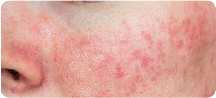 Closeup of a woman having inflammation on her face