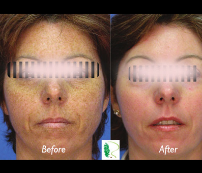 The progression from the before image with wrinkles to the after image with a more youthful and refreshed appearance highlights the effectiveness of the treatment.