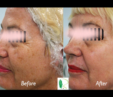 Before the youth treatment, the woman's face appeared aged, but the after image showcases a significant improvement in her facial appearance.