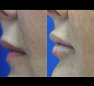 The progression from the before image with thin lips to the after image with a fuller and more defined lip profile highlights the effectiveness of the treatment.