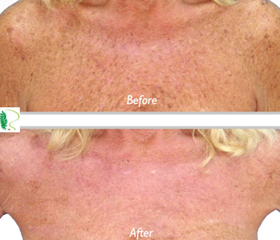 Woman chest before and after treatment