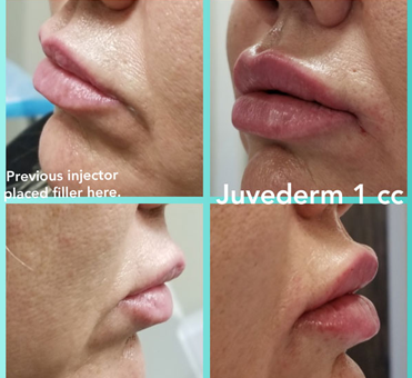 Juvederm 1cc lip treatment
