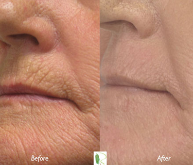 Treatment has visibly enhanced the woman's overall facial appearance, as evident in the side-by-side comparison of the two images.