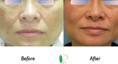 In the before photo, the man's lips appear thin and lack volume, but in the after image, the lip treatment has significantly enhanced her lip appearance.