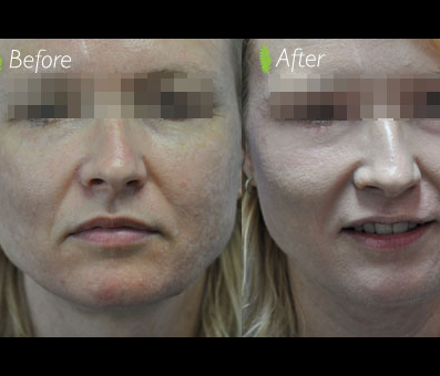 The woman's face in the before image shows wrinkles and fine lines, while the after picture reveals a remarkable transformation following youth treatment.