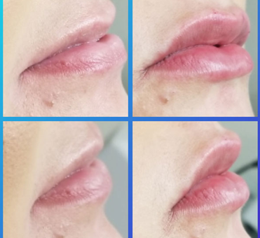 The change in the woman's lip appearance from before to after lip treatment is truly remarkable, showcasing a more plump and defined look.