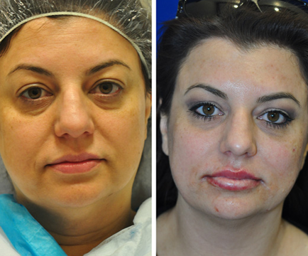 Woman's face in the before image appears to show sagging skin and wrinkles, while the after picture reveals a remarkable transformation after undergoing Y-Lift treatment.